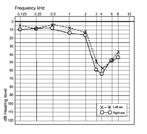 High Frequency hearing loss